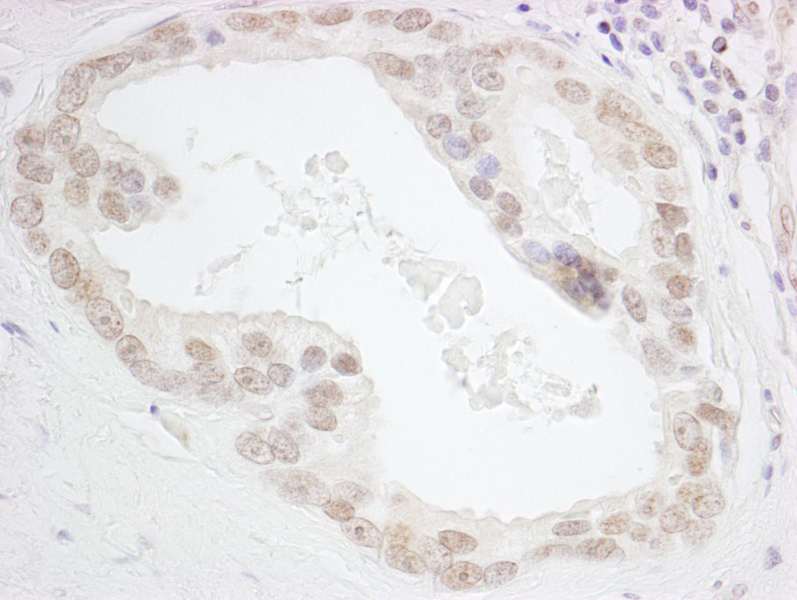 Detection of Human HMGN3 by Immunohistochemistry. Sample: FFPE section of human prostate carcinoma. Antibody: Affinity purified rabbit anti-HMGN3 used at a dilution of 1:1000 (0.2 Detection: DAB.