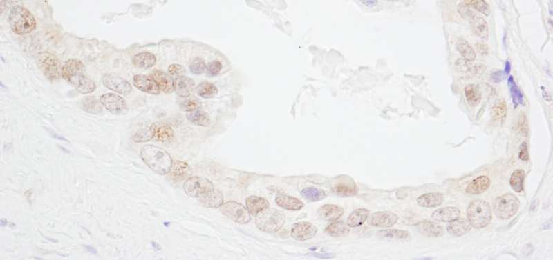 Detection of Human HMGN3 by Immunohistochemistry. Sample: FFPE section of human prostate carcinoma. Antibody: Affinity purified rabbit anti-HMGN3 used at a dilution of 1:1000 (1 Detection: DAB.