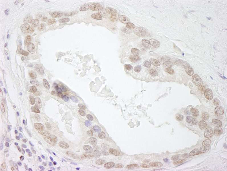 Detection of Human HMGN3 by Immunohistochemistry. Sample: FFPE section of human prostate adenocarcinoma. Antibody: Affinity purified rabbit anti-HMGN3 used at a dilution of 1:500.