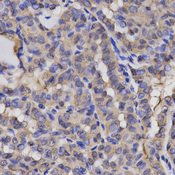 Immunohistochemistry of paraffin-embedded human thyroid cancer using HMMR antibody at dilution of 1:200 (x400 lens)