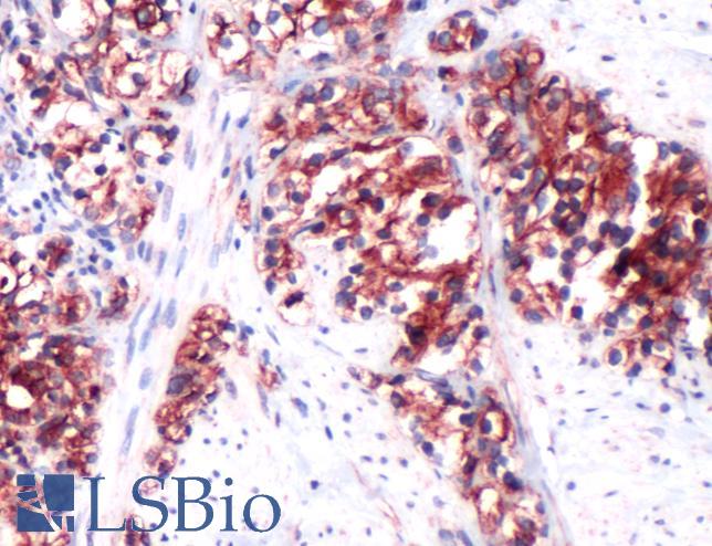 Immunohistochemistry of Human Prostate Carcinoma stained with anti-CD168 antibody