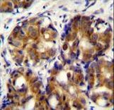 HMMR Antibody immunohistochemistry of formalin-fixed and paraffin-embedded human breast carcinoma followed by peroxidase-conjugated secondary antibody and DAB staining.