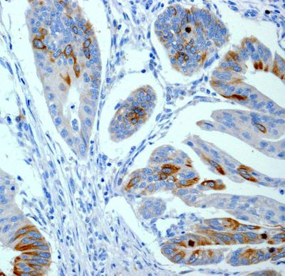 IHC of paraffin-embedded human breast carcinoma tissue using anti-CD168 / RHAMM antibody.