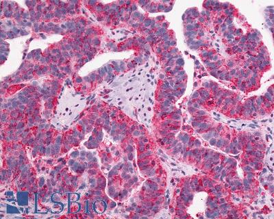 Anti-GPR1 antibody IHC of human Ovary, Carcinoma. Immunohistochemistry of formalin-fixed, paraffin-embedded tissue after heat-induced antigen retrieval.