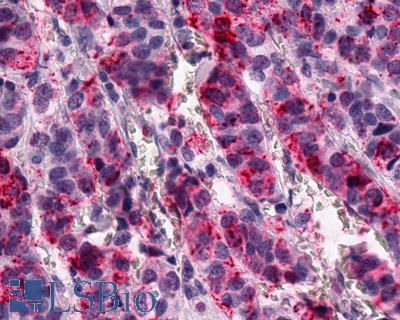 Anti-GPR1 antibody IHC of human Breast, Carcinoma. Immunohistochemistry of formalin-fixed, paraffin-embedded tissue after heat-induced antigen retrieval.