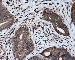 IHC of paraffin-embedded Adenocarcinoma of colon tissue using anti-MTRF1L mouse monoclonal antibody. (Dilution 1:50).