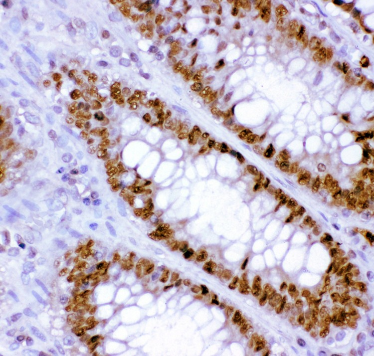HNF-4-alpha antibody IHC-paraffin: Human Intestinal Cancer Tissue.