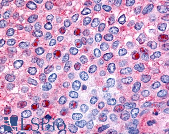 Anti-HNF4G / HNF4 Gamma antibody IHC of human Breast, Carcinoma. Immunohistochemistry of formalin-fixed, paraffin-embedded tissue after heat-induced antigen retrieval.