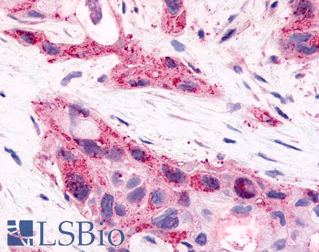 Anti-HNF4G / HNF4 Gamma antibody IHC of human Pancreas, Carcinoma. Immunohistochemistry of formalin-fixed, paraffin-embedded tissue after heat-induced antigen retrieval.