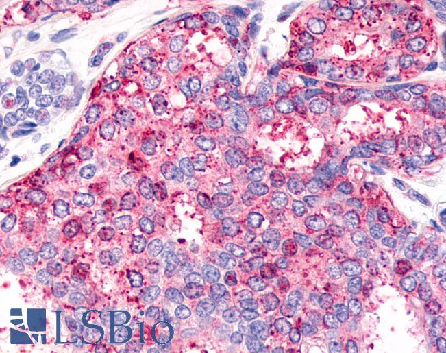 Anti-HNF4G / HNF4 Gamma antibody IHC of human Breast, Carcinoma. Immunohistochemistry of formalin-fixed, paraffin-embedded tissue after heat-induced antigen retrieval.