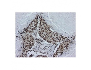 Staining of paraffin lung tissue sections showing squamous cell carcinoma, using hnRNP A2B1 antibody