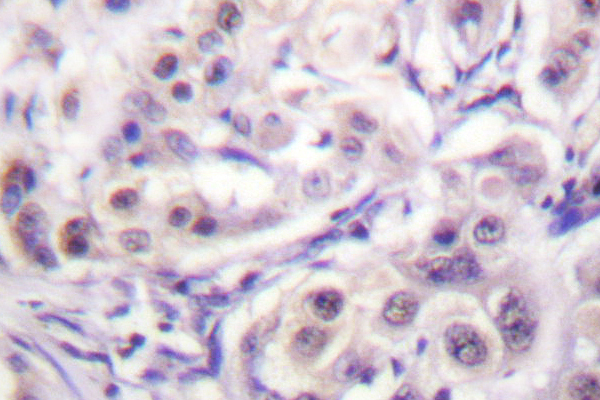 IHC of hnRPD (H79) pAb in paraffin-embedded human lung carcinoma tissue.