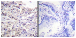 IHC of paraffin-embedded human lung carcinoma, using hnRPD (Phospho-Ser83) Antibody. The sample on the right was incubated with synthetic peptide.