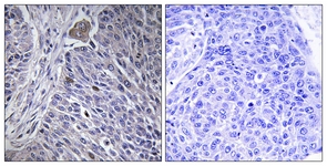 IHC of paraffin-embedded human lung carcinoma tissue, using HNRPDL Antibody. The sample on the right was incubated with synthetic peptide.