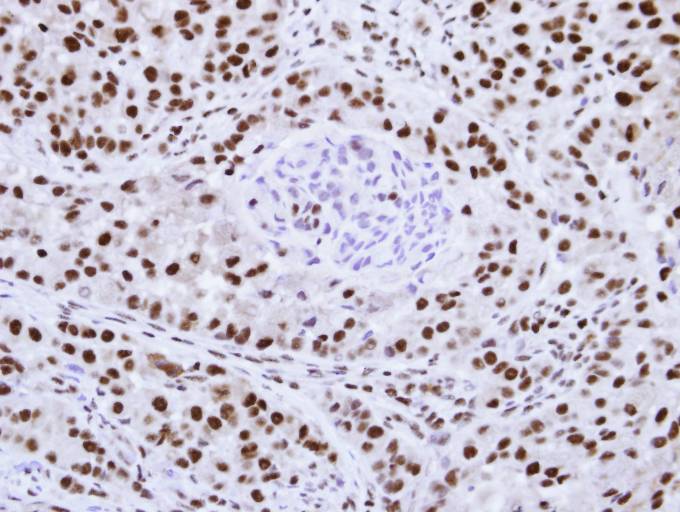 IHC of paraffin-embedded A549 Xenograft using hnRNP F antibody at 1:100 dilution.