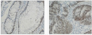Left and Center: IHC of normal colon (left) and colon carninoma (center) using hnRNP-K antibody (LS-C27036). Right: Western blot of hnRNP-K antibody on Calu6 (1) and HT29 (2) cell lysates.