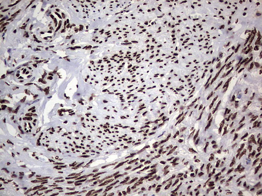 IHC of paraffin-embedded Adenocarcinoma of Human endometrium tissue using anti-HNRNPL mouse monoclonal antibody. (Heat-induced epitope retrieval by 1 mM EDTA in 10mM Tris, pH8.5, 120°C for 3min).