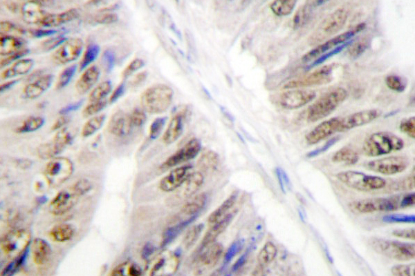 IHC of hnRNP L (G58) pAb in paraffin-embedded human colon carcinoma tissue.