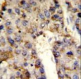 Formalin-fixed and paraffin-embedded human hepatocarcinoma reacted with HNRPL Antibody , which was peroxidase-conjugated to the secondary antibody, followed by DAB staining. This data demonstrates the use of this antibody for immunohistochemistry; clinical relevance has not been evaluated.