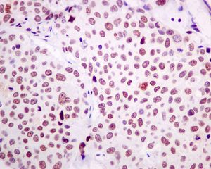 IHC of paraffin-embedded human lung adenocarcinoma tissue using anti-HNRNPUL1 / HNRPUL1 antibody.