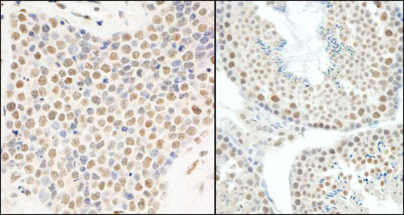 Detection of Human and Mouse E1B-AP5 by Immunohistochemistry. Sample: FFPE section of human small cell lung cancer (left) and mouse testis (right). Antibody: Affinity purified rabbit anti-E1B-AP5 used at a dilution of 1:200 (1 Detection: DAB.