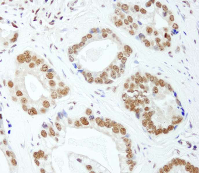 Detection of Human E1B-AP5 by Immunohistochemistry. Sample: FFPE section of human prostate carcinoma. Antibody: Affinity purified rabbit anti-E1B-AP5 used at a dilution of 1:200 (1 Detection: DAB.