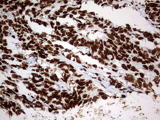 IHC of paraffin-embedded Adenocarcinoma of Human endometrium tissue using anti-HNRNPM mouse monoclonal antibody. (Heat-induced epitope retrieval by 1 mM EDTA in 10mM Tris, pH9.0, 120°C for 3min).