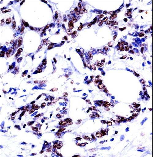 HNRNPM Antibody immunohistochemistry of formalin-fixed and paraffin-embedded human colon carcinoma followed by peroxidase-conjugated secondary antibody and DAB staining.