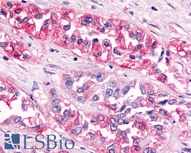 Anti-GPR119 antibody IHC of human Pancreas, Carcinoma. Immunohistochemistry of formalin-fixed, paraffin-embedded tissue after heat-induced antigen retrieval.