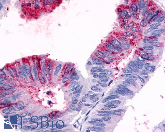 Anti-GPR119 antibody IHC of human Colon, Carcinoma. Immunohistochemistry of formalin-fixed, paraffin-embedded tissue after heat-induced antigen retrieval.