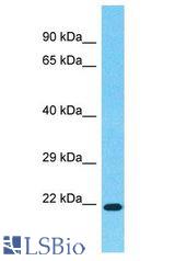 HOXA7 antibody Western Blot of Colorectal Tumor. Antibody dilution: 1 ug/ml.
