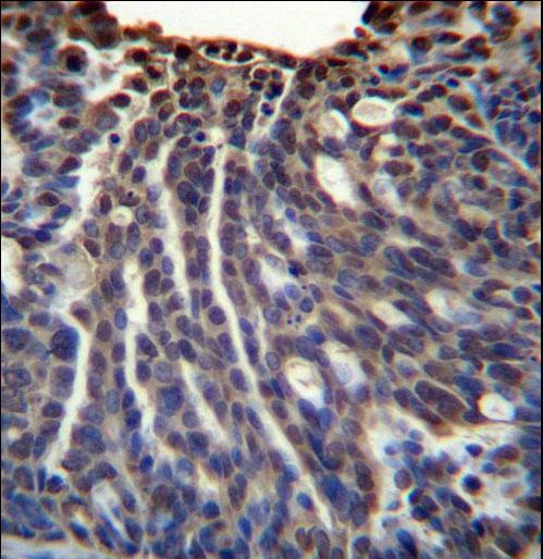 HOXB3 Antibody immunohistochemistry of formalin-fixed and paraffin-embedded human ovarian carcinoma followed by peroxidase-conjugated secondary antibody and DAB staining.