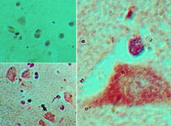 IHC of HOXB4 in formalin-fixed, paraffin-embedded human brain tissue using an isotype control (top left) and LS-C148633 (bottom left, right) at 5 ug/ml.