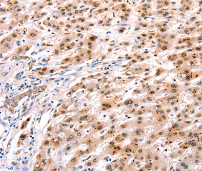 Immunohistochemistry of paraffin-embedded Human liver cancer tissue using HOXC8 antibody.
