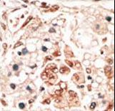 Formalin-fixed and paraffin-embedded human cancer tissue reacted with the primary antibody, which was peroxidase-conjugated to the secondary antibody, followed by DAB staining. This data demonstrates the use of this antibody for immunohistochemistry; clinical relevance has not been evaluated. BC = breast carcinoma; HC = hepatocarcinoma.