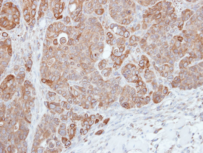 IHC of paraffin-embedded SW480 xenograft using HPS3 antibody at 1:500 dilution.