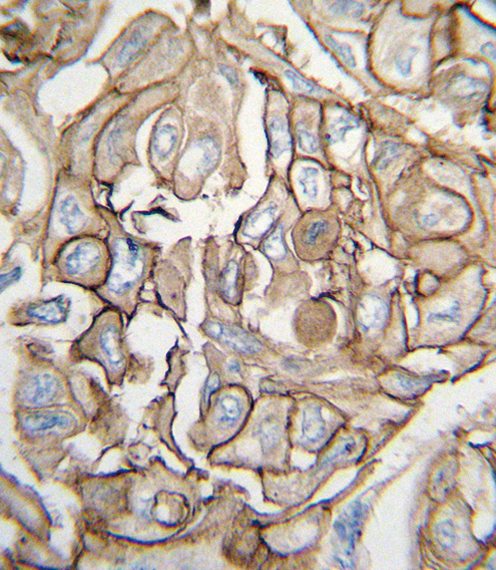 Formalin-fixed and paraffin-embedded human lung carcinoma tissue reacted with HRAS antibody , which was peroxidase-conjugated to the secondary antibody, followed by DAB staining. This data demonstrates the use of this antibody for immunohistochemistry; clinical relevance has not been evaluated.