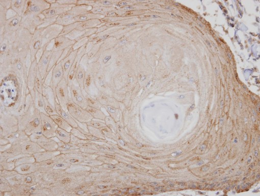 IHC of paraffin-embedded BCC2 xenograft using TM7SF1/GPR137B antibody at 1:100 dilution.