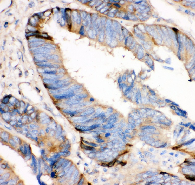 HRG antibody IHC-paraffin: Human Intestinal Cancer Tissue.
