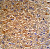 HRG Antibody (RB18729) IHC of formalin-fixed and paraffin-embedded human hepatocarcinoma tissue followed by peroxidase-conjugated secondary antibody and DAB staining.