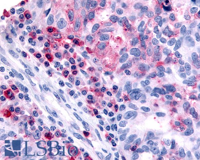 Anti-HRH4 / Histamine H4 Receptor antibody IHC of human Ovary, Carcinoma and Inflammatory Cells. Immunohistochemistry of formalin-fixed, paraffin-embedded tissue after heat-induced antigen retrieval.