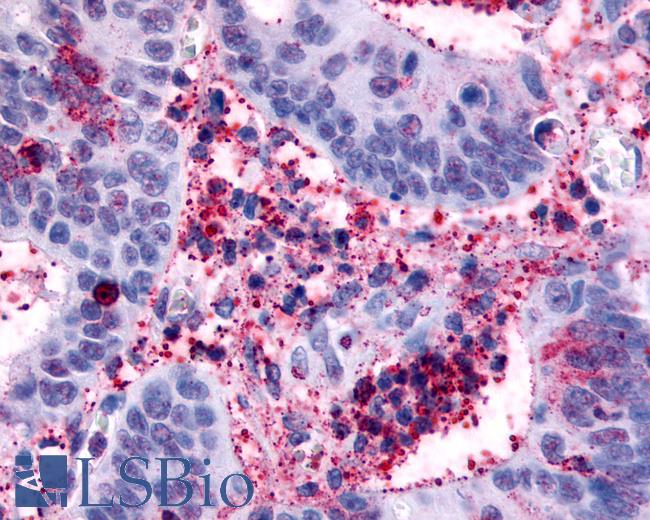 Anti-HRH4 / Histamine H4 Receptor antibody IHC of human Colon, Carcinoma and Inflammatory Cells. Immunohistochemistry of formalin-fixed, paraffin-embedded tissue after heat-induced antigen retrieval.