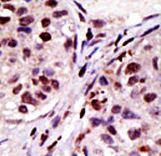 Formalin-fixed and paraffin-embedded human cancer tissue reacted with the primary antibody, which was peroxidase-conjugated to the secondary antibody, followed by AEC staining. This data demonstrates the use of this antibody for immunohistochemistry; clinical relevance has not been evaluated. BC = breast carcinoma; HC = hepatocarcinoma.