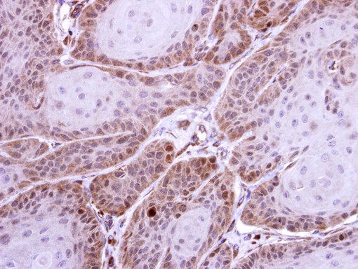 IHC of paraffin-embedded Cal27 xenograft using HS1BP3 antibody at 1:500 dilution.