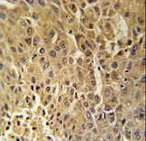 DHB13 Antibody immunohistochemistry of formalin-fixed and paraffin-embedded human hepatocarcinoma followed by peroxidase-conjugated secondary antibody and DAB staining.