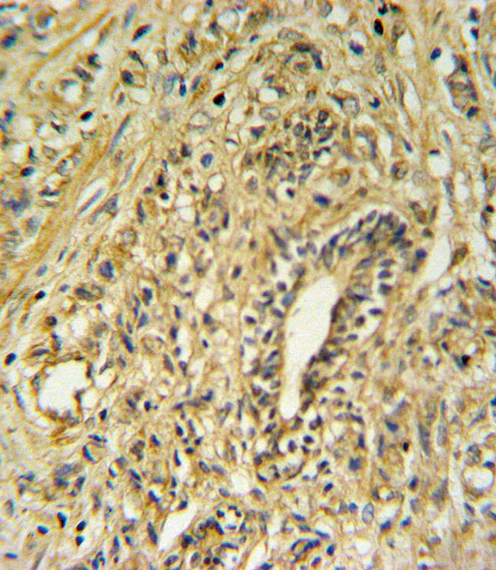 HSD17B2 Antibody IHC of formalin-fixed and paraffin-embedded human prostate carcinoma followed by peroxidase-conjugated secondary antibody and DAB staining.
