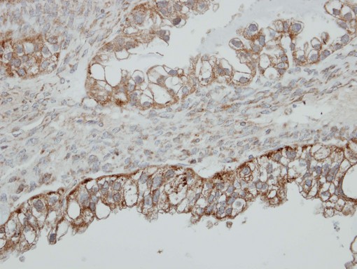 IHC of paraffin-embedded OVCA using HSD17B4 antibody at 1:500 dilution.