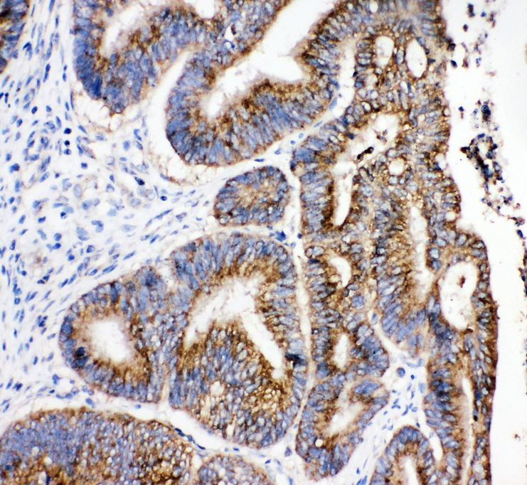 HSD17B4 antibody. IHC(P): Human Intestinal Cancer Tissue.