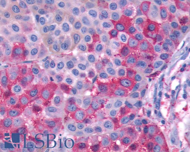 Anti-GPR143 antibody IHC of human Skin, Melanoma. Immunohistochemistry of formalin-fixed, paraffin-embedded tissue after heat-induced antigen retrieval.