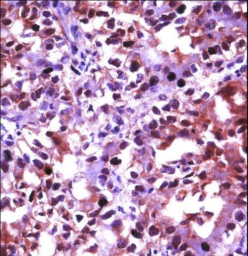 HSF1 Antibody immunohistochemistry of formalin-fixed and paraffin-embedded human kidney carcinoma followed by peroxidase-conjugated secondary antibody and DAB staining.